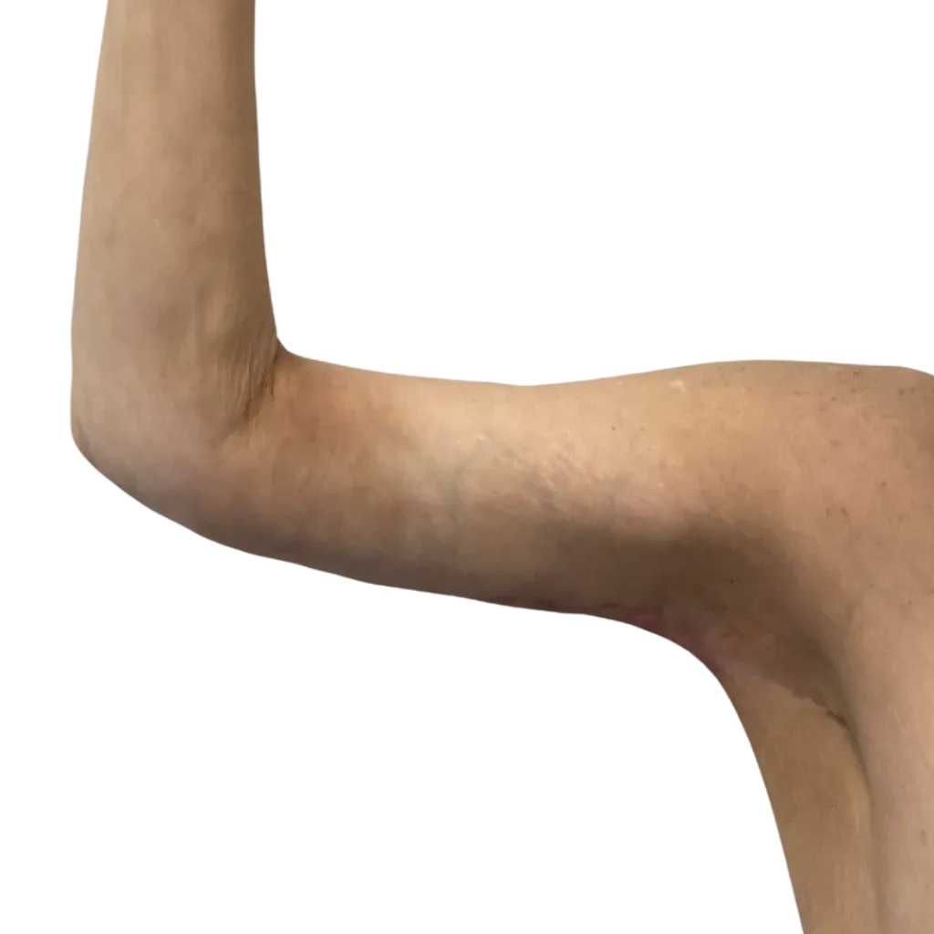 Bent arm bent at the elbow against a white background, showing skin with visible discoloration.