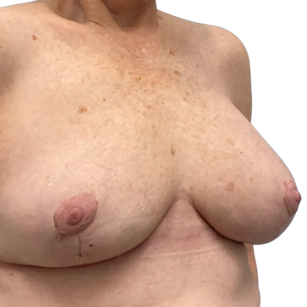 Close-up of a person’s bare torso, showing prominent breasts against a plain white background.