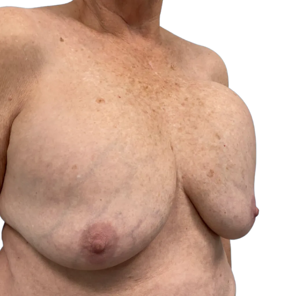 Close-up of an adult torso with prominent breast tissue against a plain white background