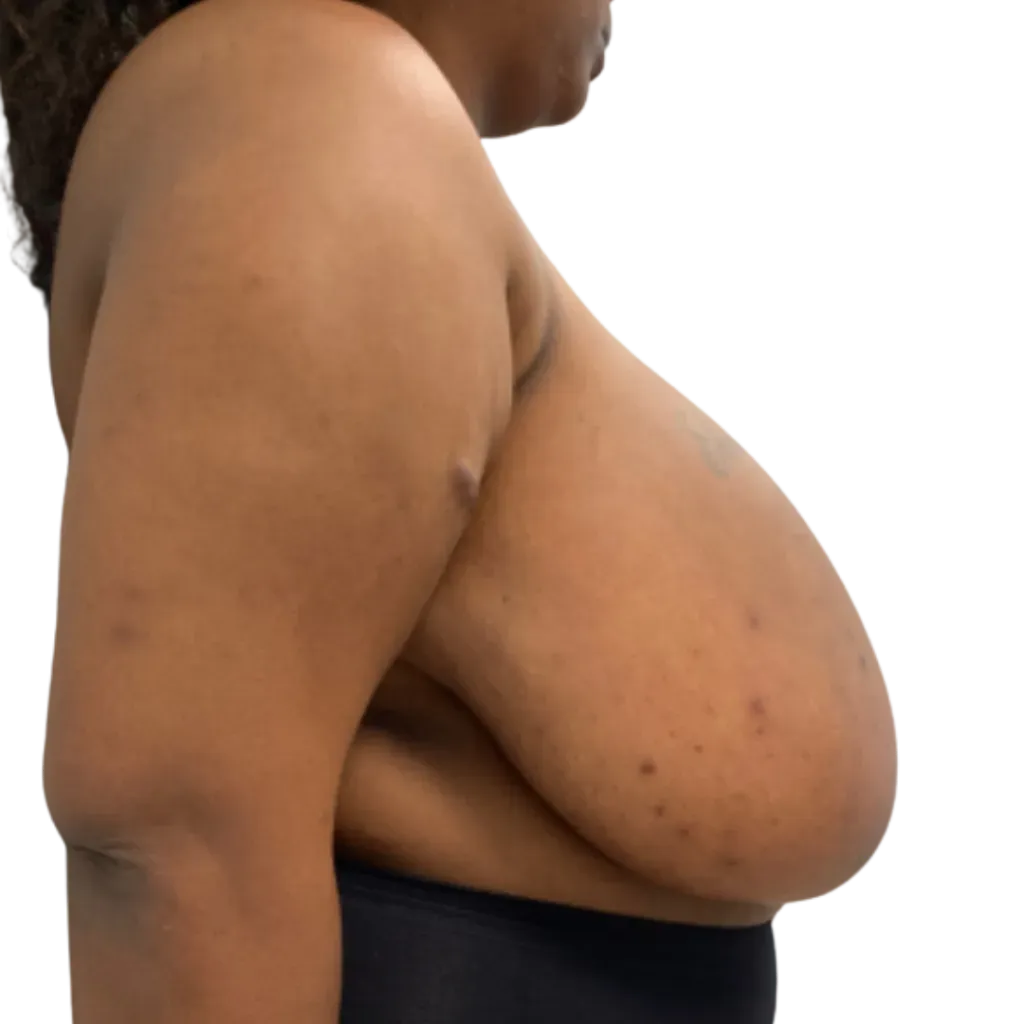 Side view of a person in a black top, showing visible skin folds on the upper arm and chest.