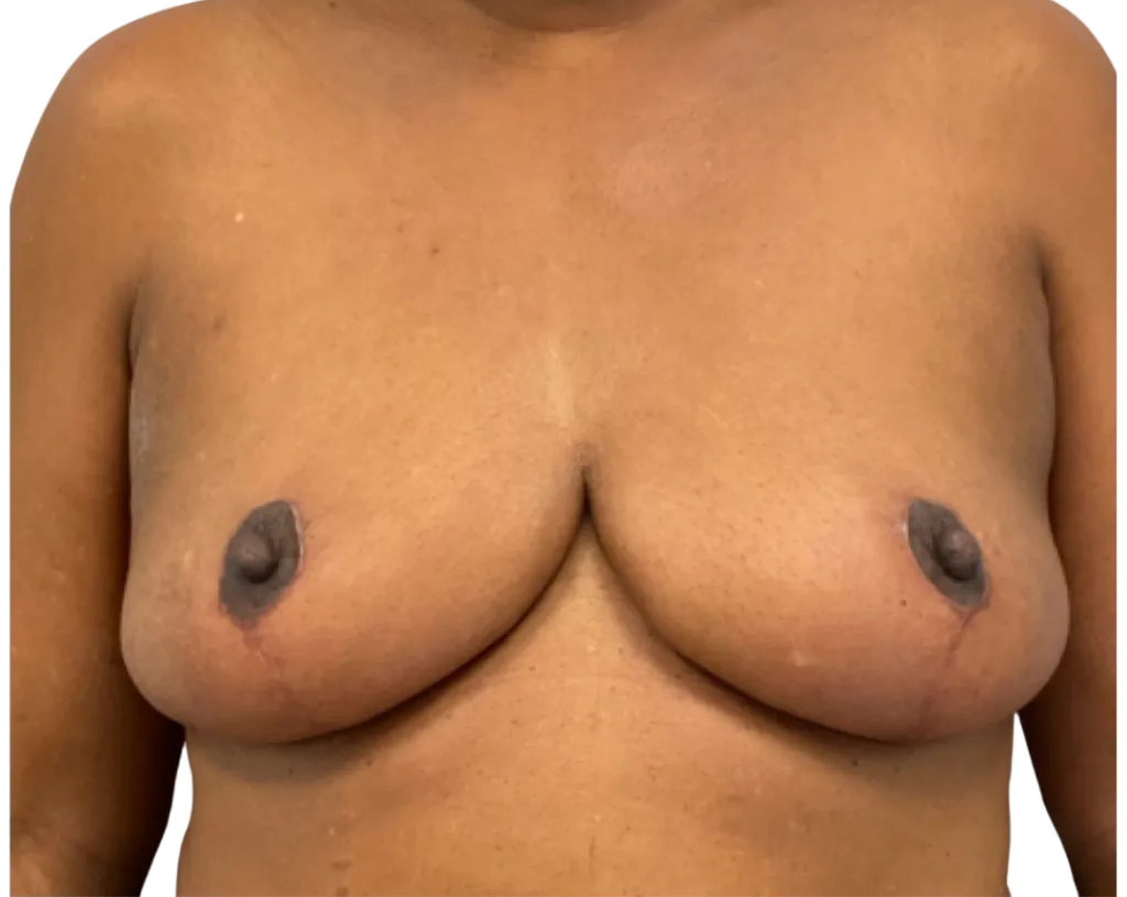 Front view of an unclothed chest with visible breast asymmetry against a plain background