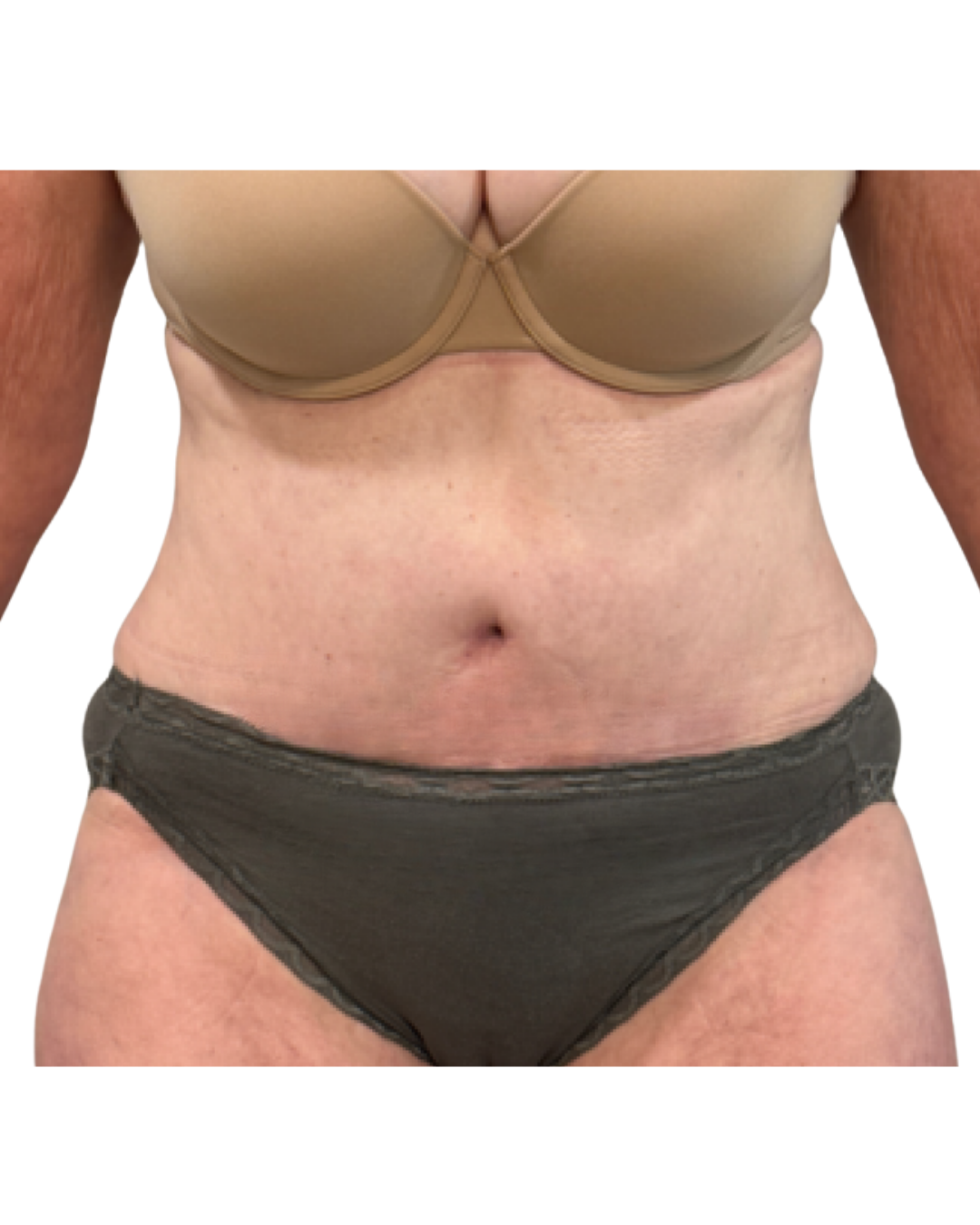 Bent arm bent at the elbow against a white background, showing skin with visible discoloration.