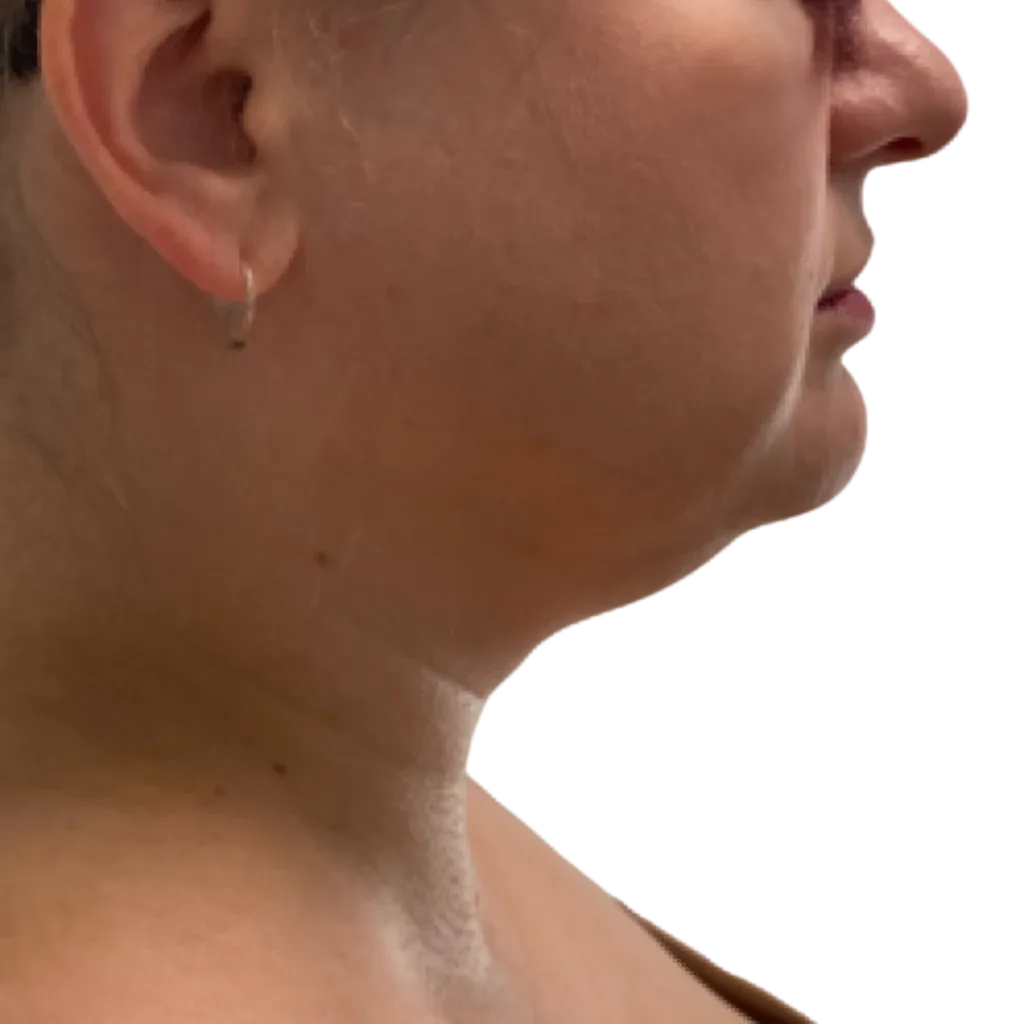 Side profile of a person’s face and neck against a plain white background