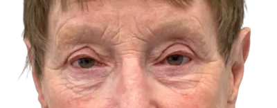 Close-up of a person's eyes and upper face, showing redness and puffiness around the eyelids.