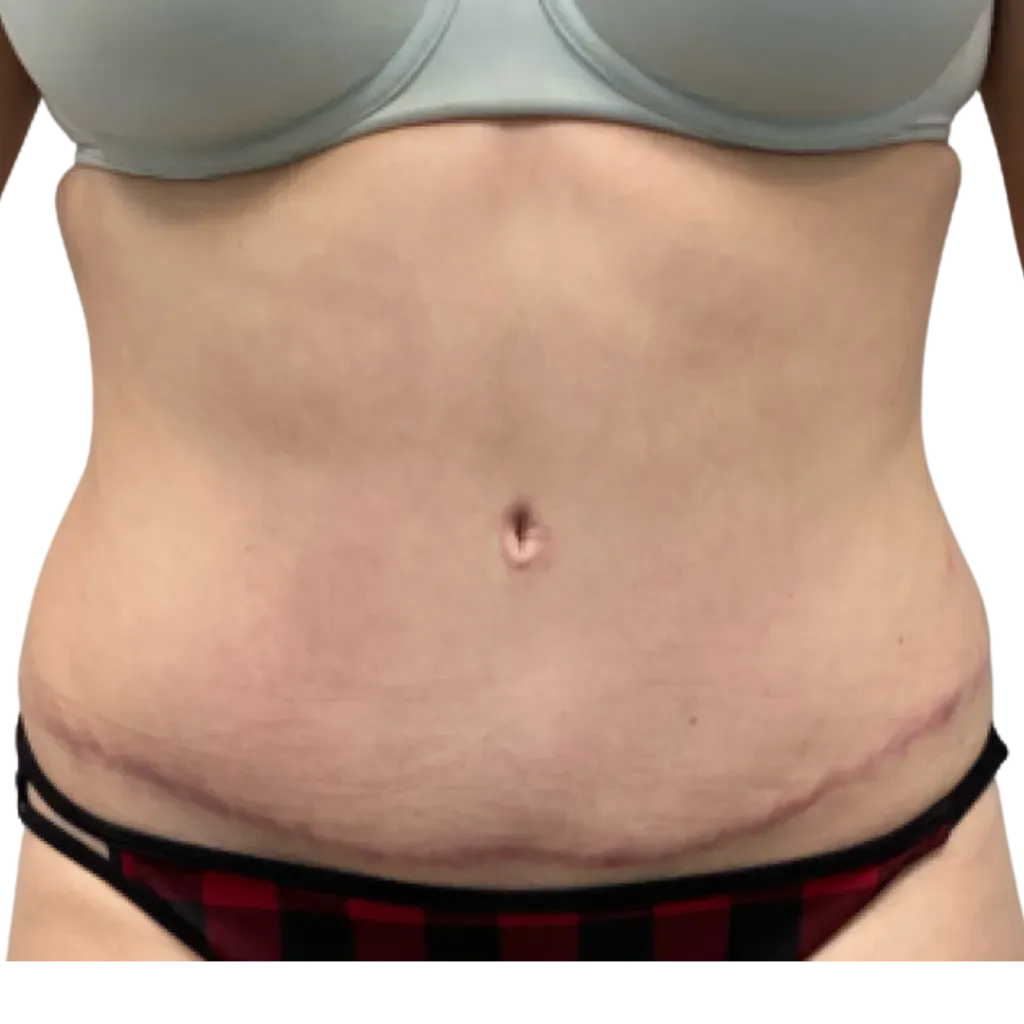 Midsection in gray bra and red-and-black underwear, showing a navel and visible skin folds.