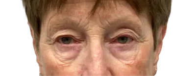 Close-up of a person’s eyes and upper face, showing visible under-eye puffiness and redness