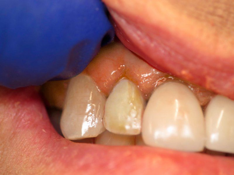 Close-up of teeth with a slightly yellow tooth. A gloved hand touches the teeth in a mouth.