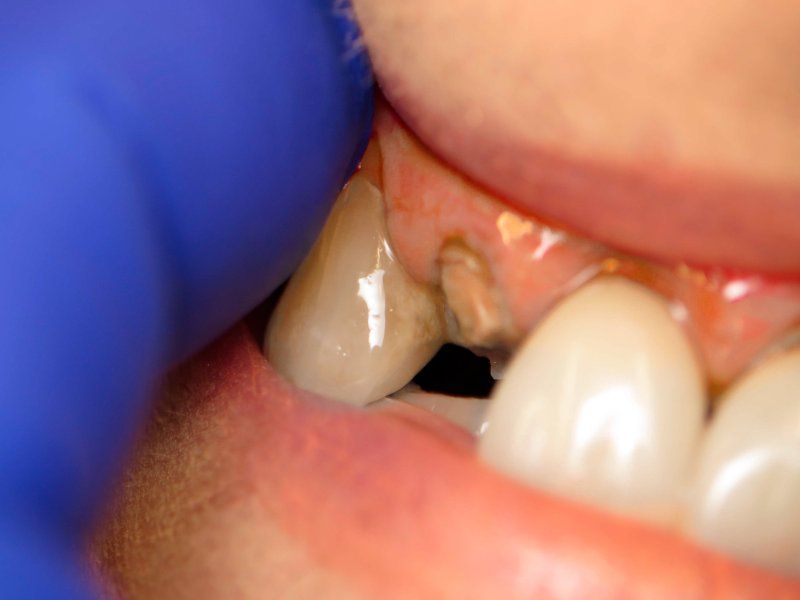 Close-up view of a person's teeth, showing a cavity and healthy tooth beside it. Blue gloved hand visible.