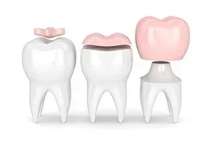 Dental crown models. Three teeth with pink crowns in different stages of placement.
