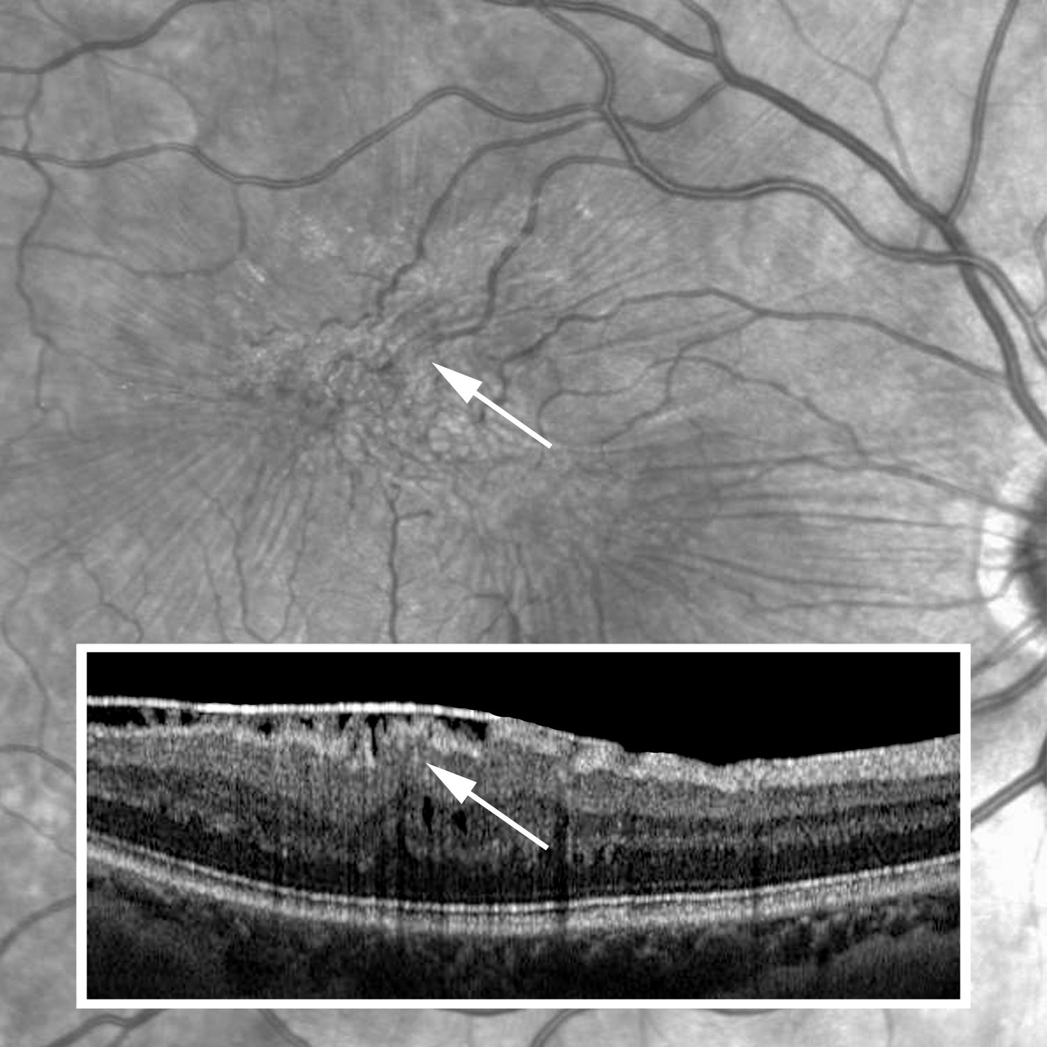 optische Kohärenztomografie Makula, epiretinale Gliose, Abbildung optische Kohärenztomografie Makula, epiretinale Gliose, Abbildung