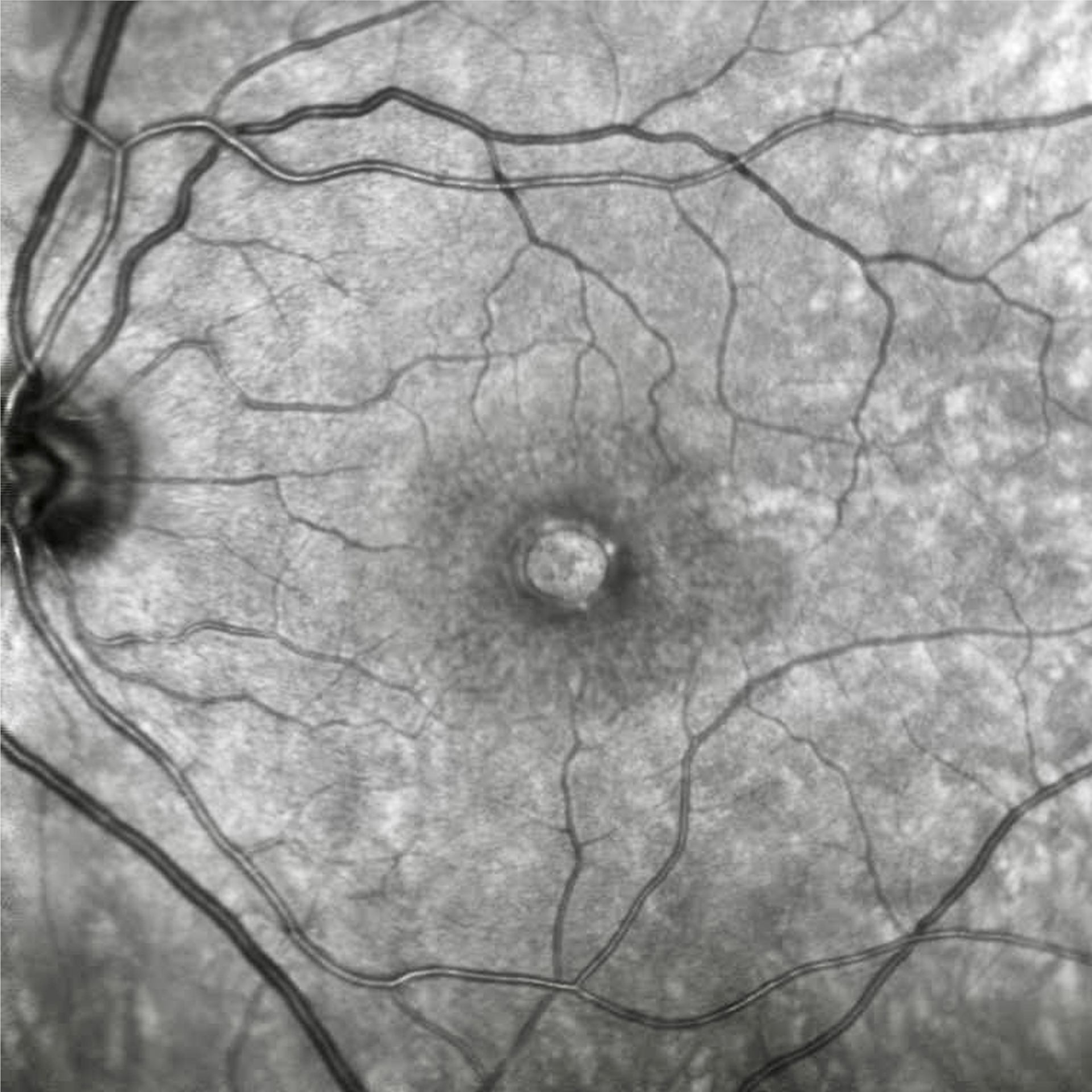 Makulaforamen, Foto Netzhautscan und Gesichtsfeld bei Makulaforamen, Foto