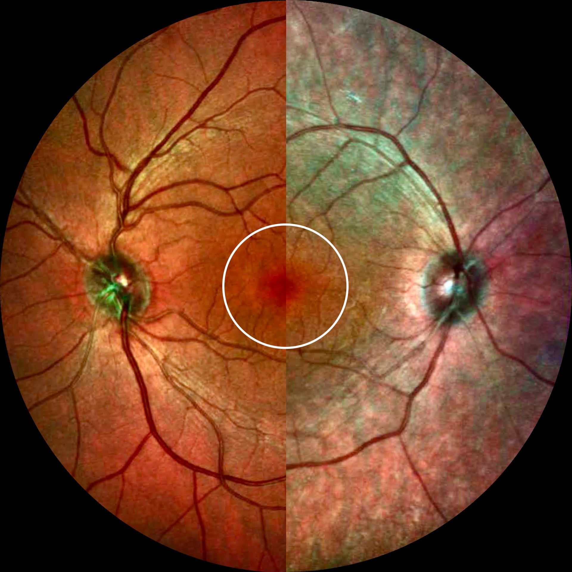 Retinitis pigmentosa, Netzhautfoto Retinitis pigmentosa, Netzhautfoto