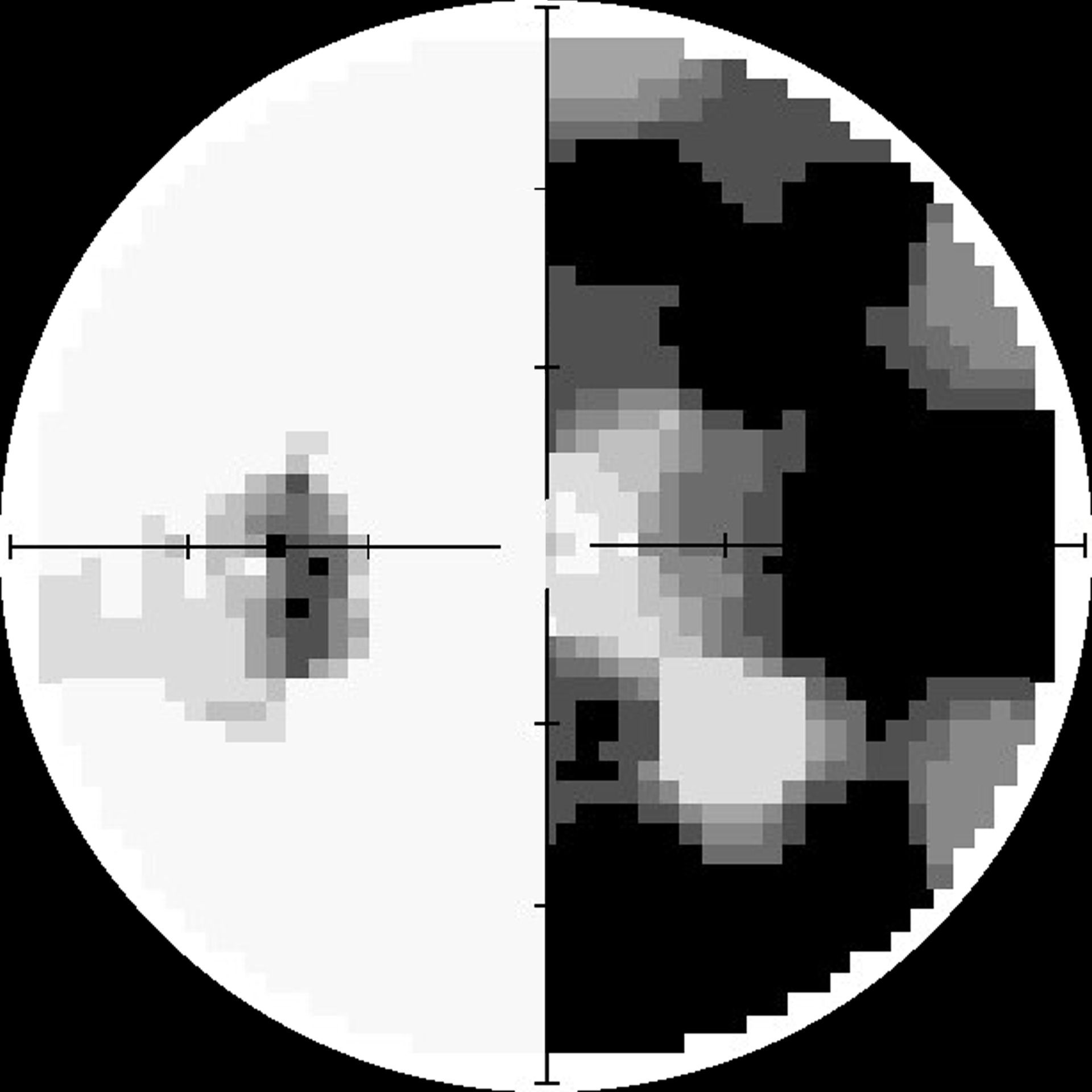 Retinitis pigmentosa, Gesichtsfeld Retinitis pigmentosa, Gesichtsfeld