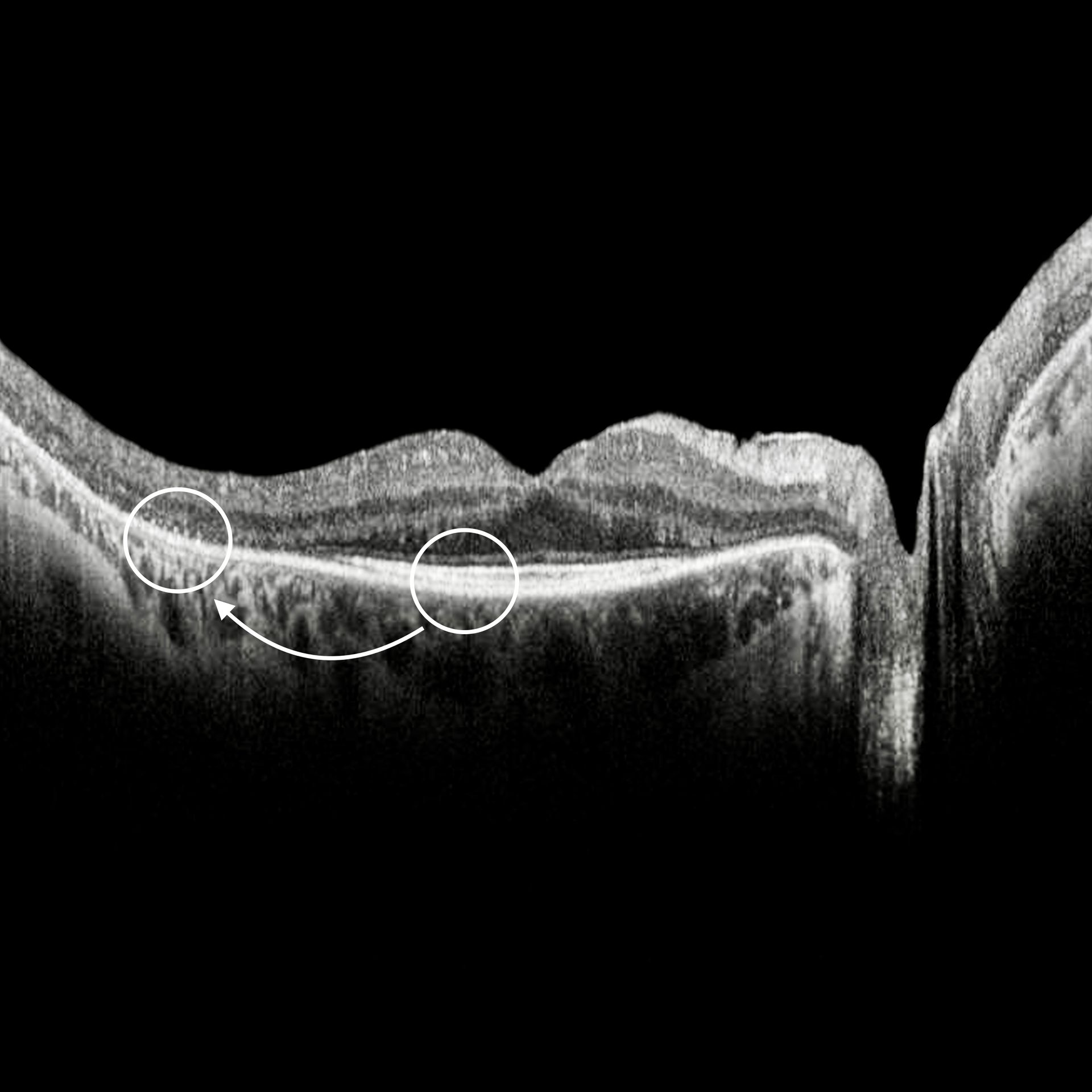 Retinitis pigmentosa, OCT Retinitis pigmentosa, OCT