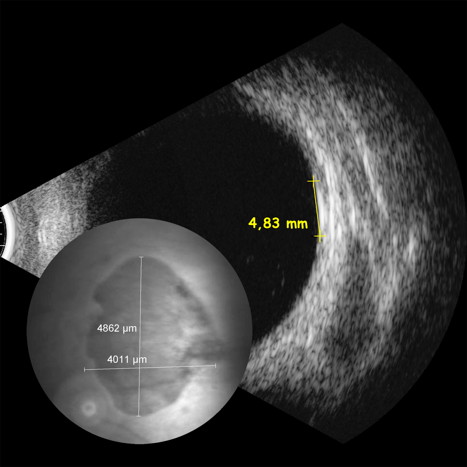 Aderhautnävus, Ultraschall, Abbildung Aderhautnävus, Ultraschall, Abbildung
