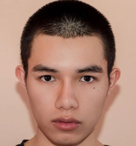 after acne scar removal laser treatment at The Tattoo Removal Clinic in Coventry