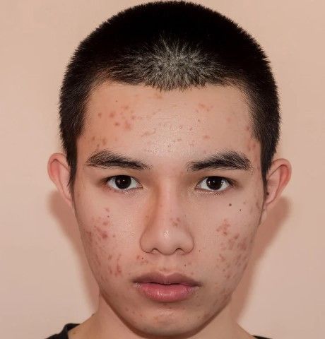 before acne scar removal laser treatment at The Tattoo Removal Clinic in Coventry