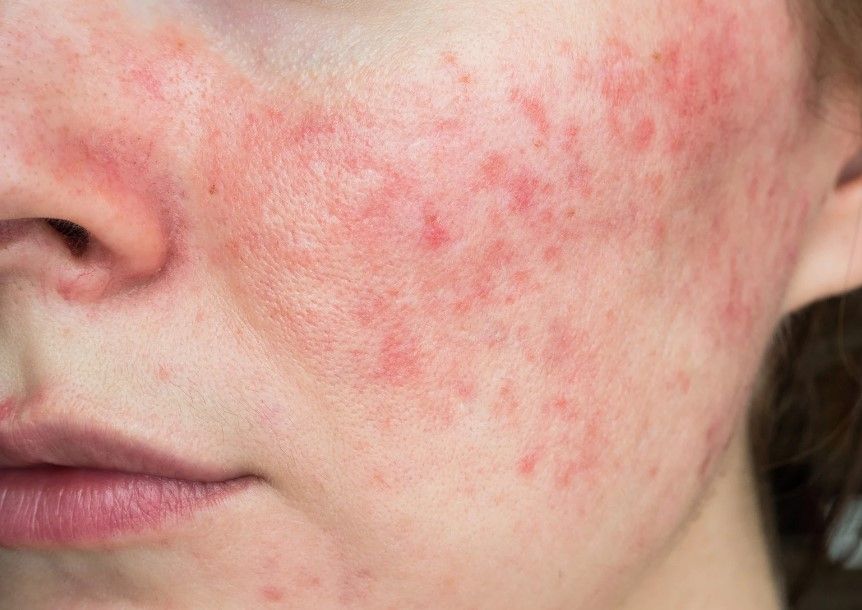 The Tattoo Removal Clinic Before Rosacea treatmentl in Coventry