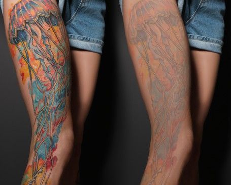 The Tattoo Removal Clinic showing the lightening of a tattoo after laser fading treatment