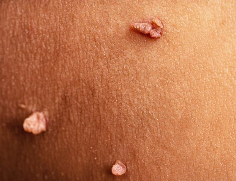 The tattoo clinic carrying out a skin consultation for a skin tag removal