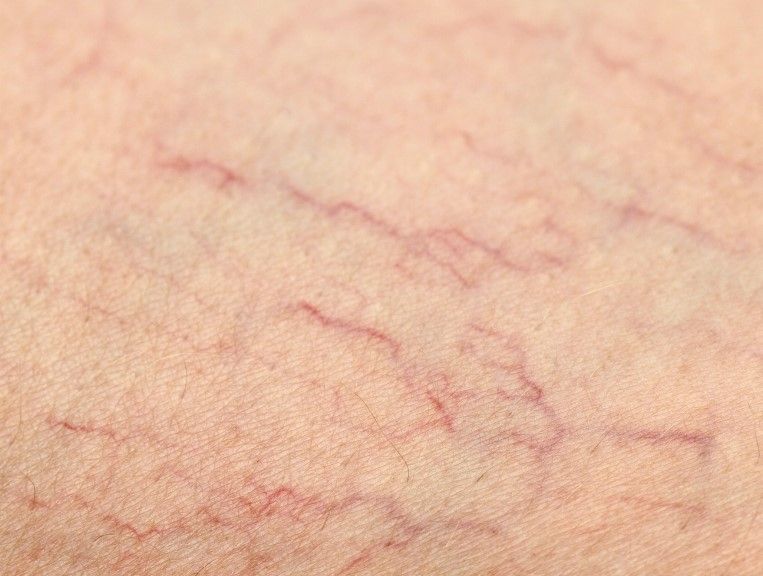 The Tattoo Removal Clinic inspecting thread veins of a client in Coventry