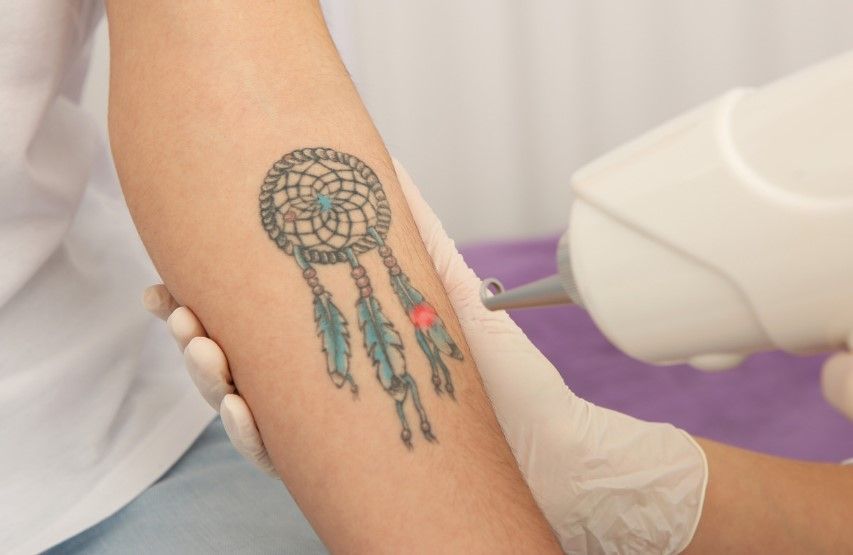The Tattoo Removal Clinic showing laser tattoo removal for a coloured tattoo