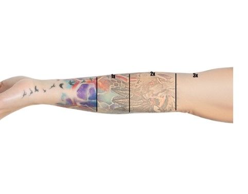 The Tattoo Removal Clinic showing the different stages of tattoo removal