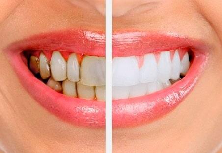 DRA. MA. PATRICIA GONZÁLEZ DÍAZ-- blanqueamiento dental