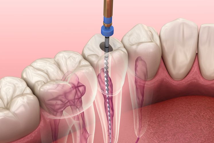 DRA. MA. PATRICIA GONZÁLEZ DÍAZ-endodoncia
