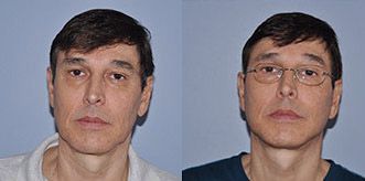 Facelift Before and After Pictures