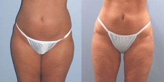 Liposuction Before and After Pictures