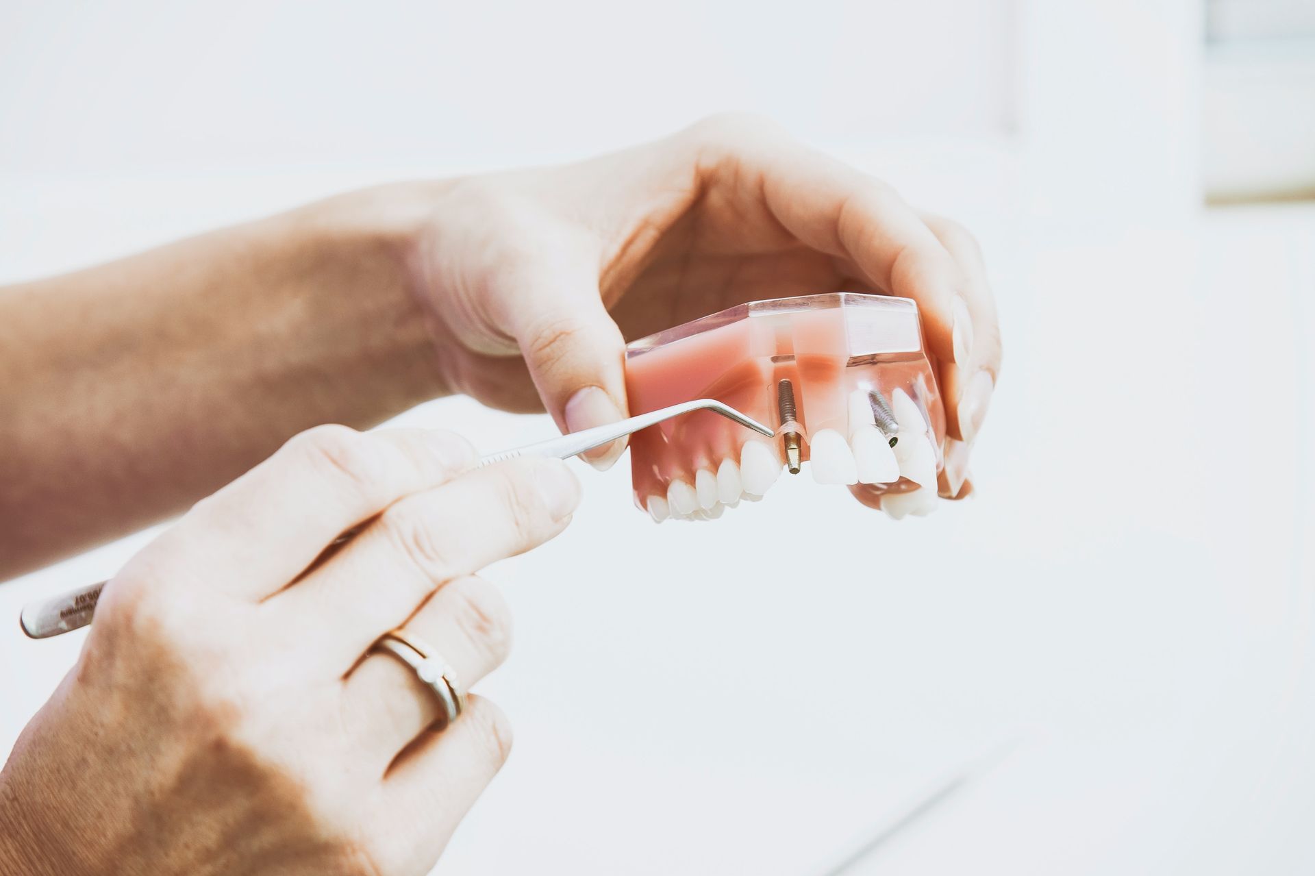 Amostra esquemática de implante dentário