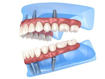 A model of a person 's teeth with dental implants.