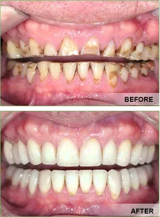 A before and after picture of a person 's teeth