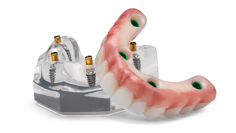 A model of a denture with dental implants on a white background.