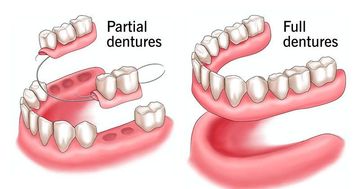 There are two different types of dentures , partial dentures and full dentures.
