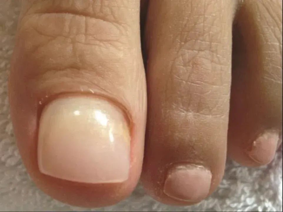 Close-up of fingernails, with one thumb nail prominently chipped and polished pale pink. — Kingscliff Podiatry Laser Clinic in Kingscliff, NSW