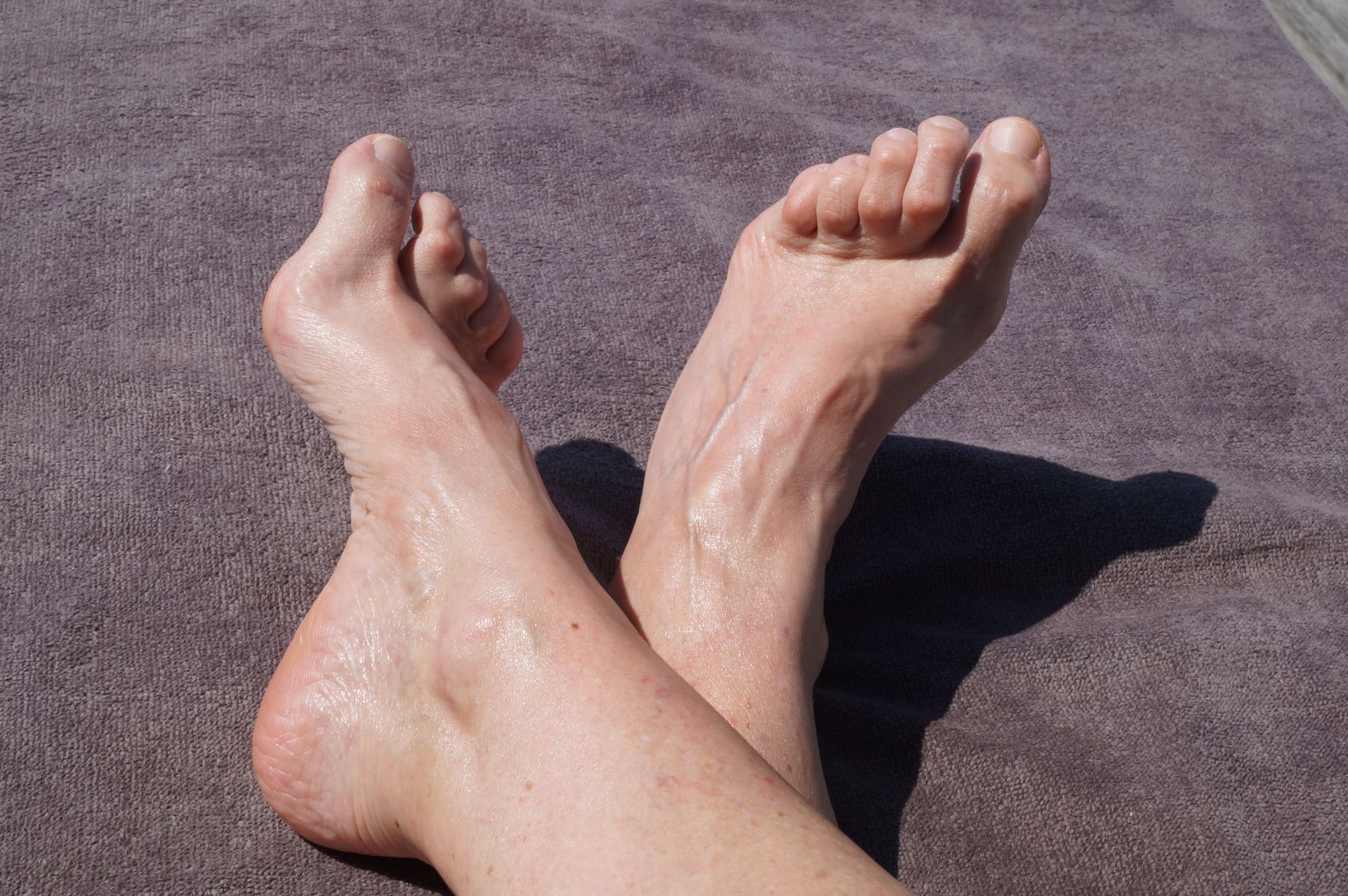 Hammertoes | Bel Air, MD | Foot Center Of Bel Air