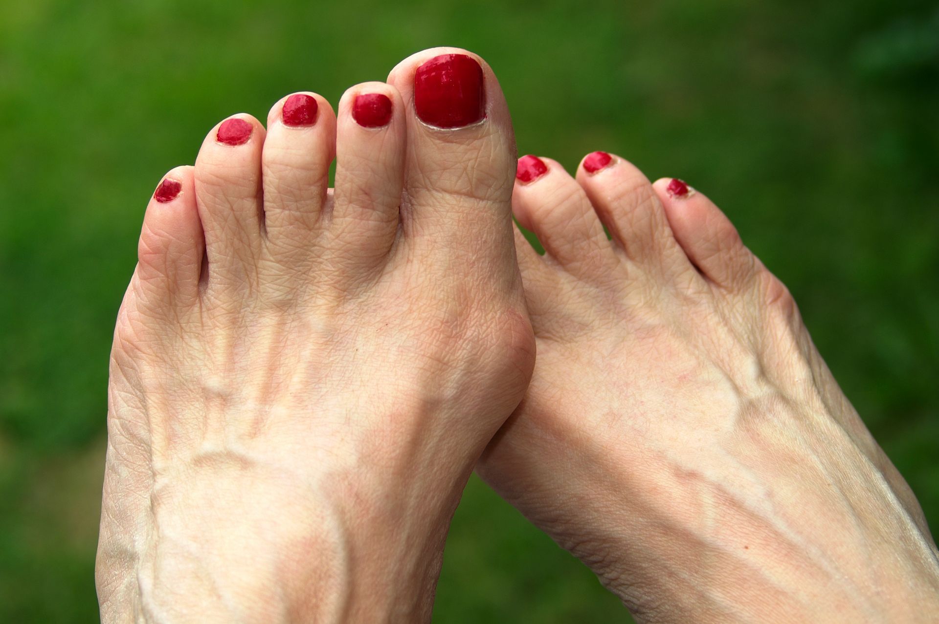 Bunions | Bel Air, MD | Foot Center Of Bel Air