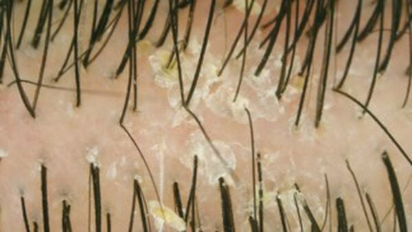 Close-up of scalp with flakes and black hairs. White, flaky patches are visible between hair strands.
