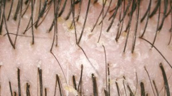 Close-up of scalp with visible hairs and areas of white flaking.