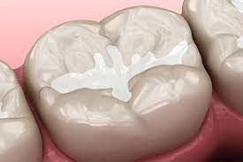 Dental filling on a molar tooth; white filling in a beige tooth; pink gumline.