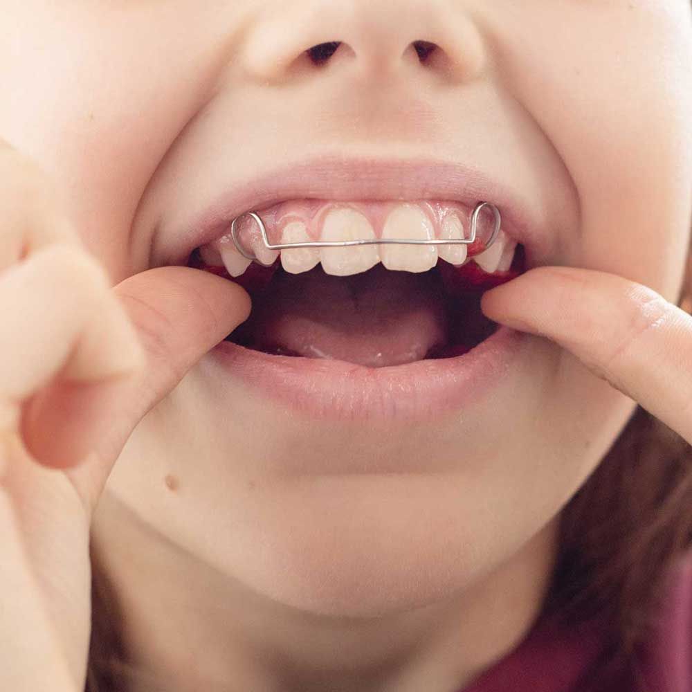 Child with removable orthodontic appliance in mouth.
