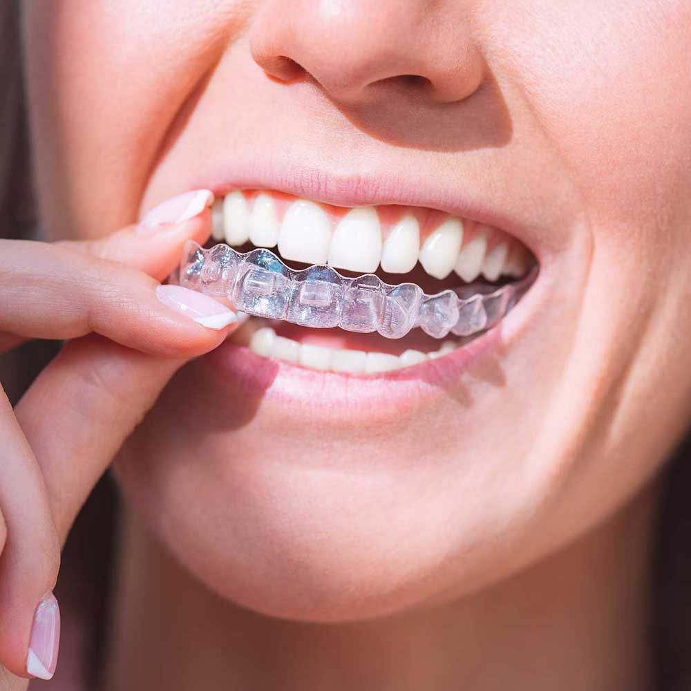Woman with perfect smile wearing invisible dental aligners for dental correction