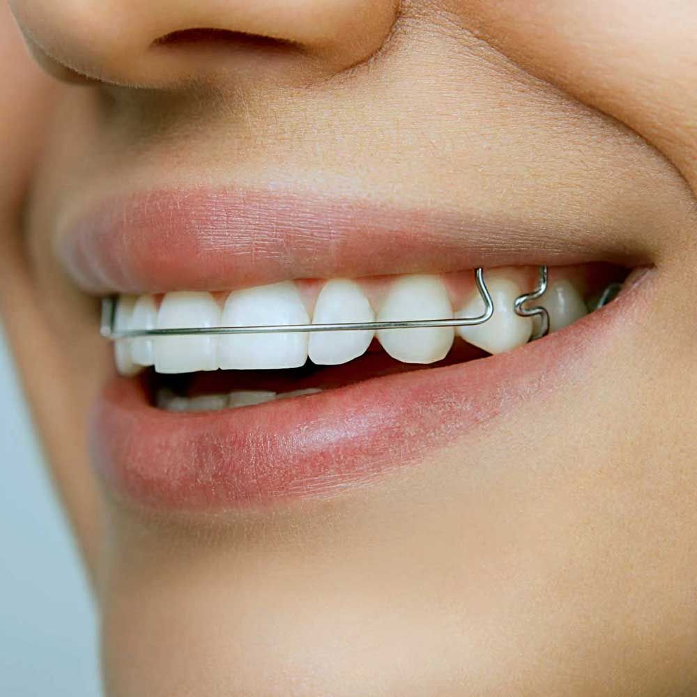 Woman in braces