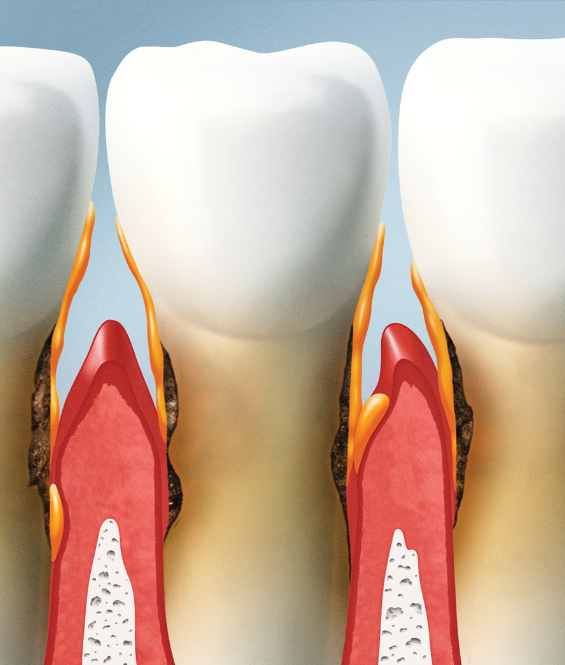 Gum Disease, Root Canals Near Oak Point TX 75068 A close up of a row of teeth with red gums