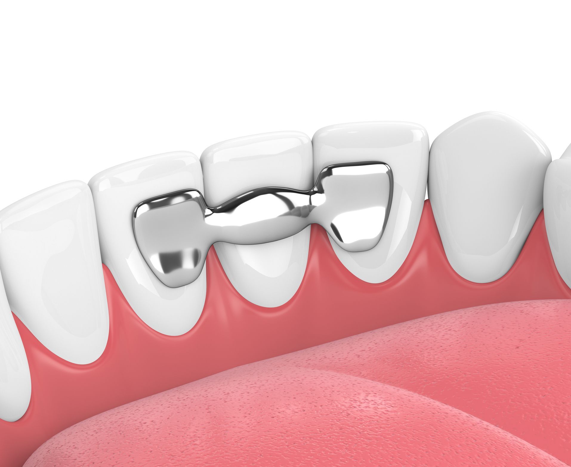 A close up of a person 's teeth with a dental bridge.