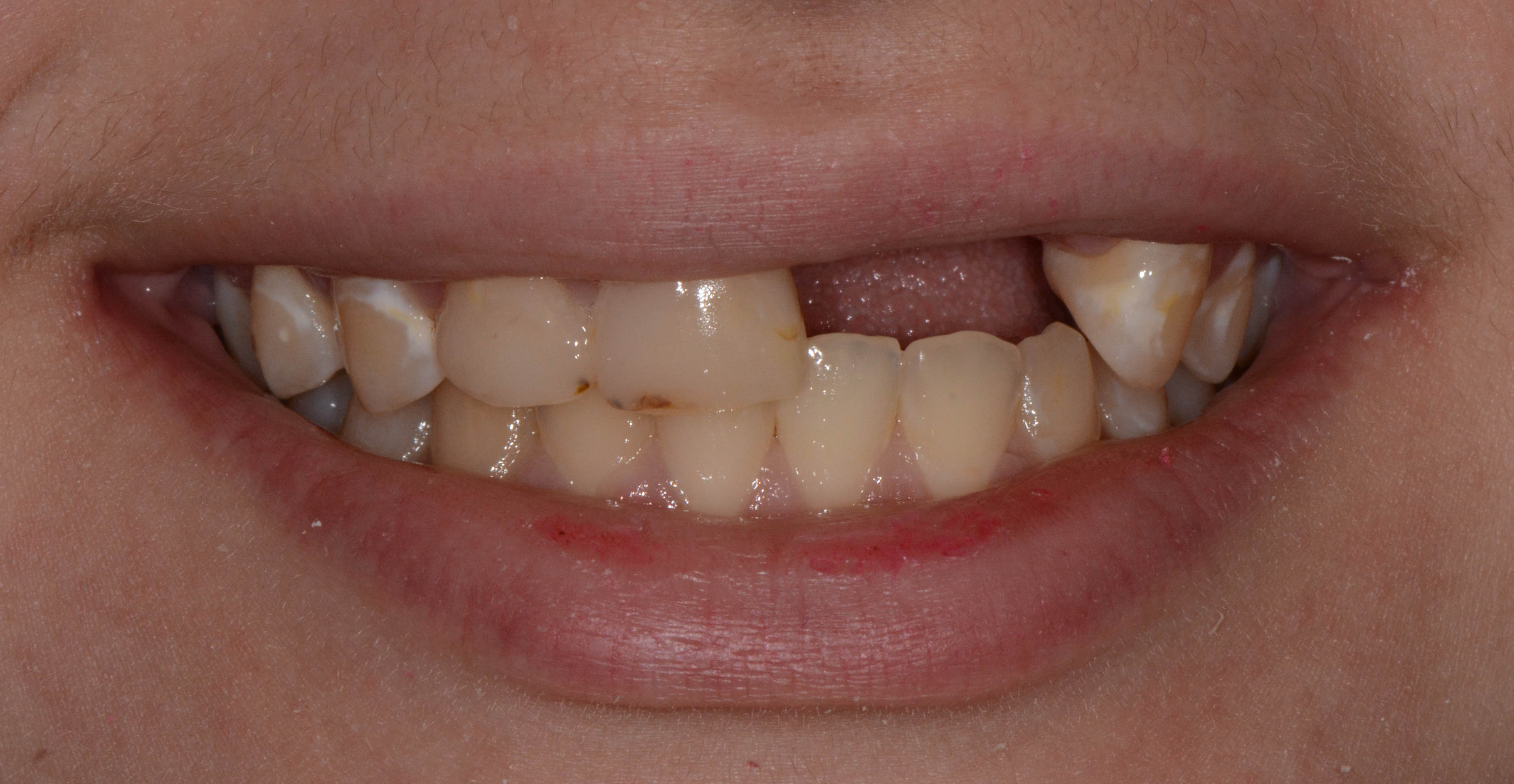 A close up of a person 's teeth with a dental implant in the middle.