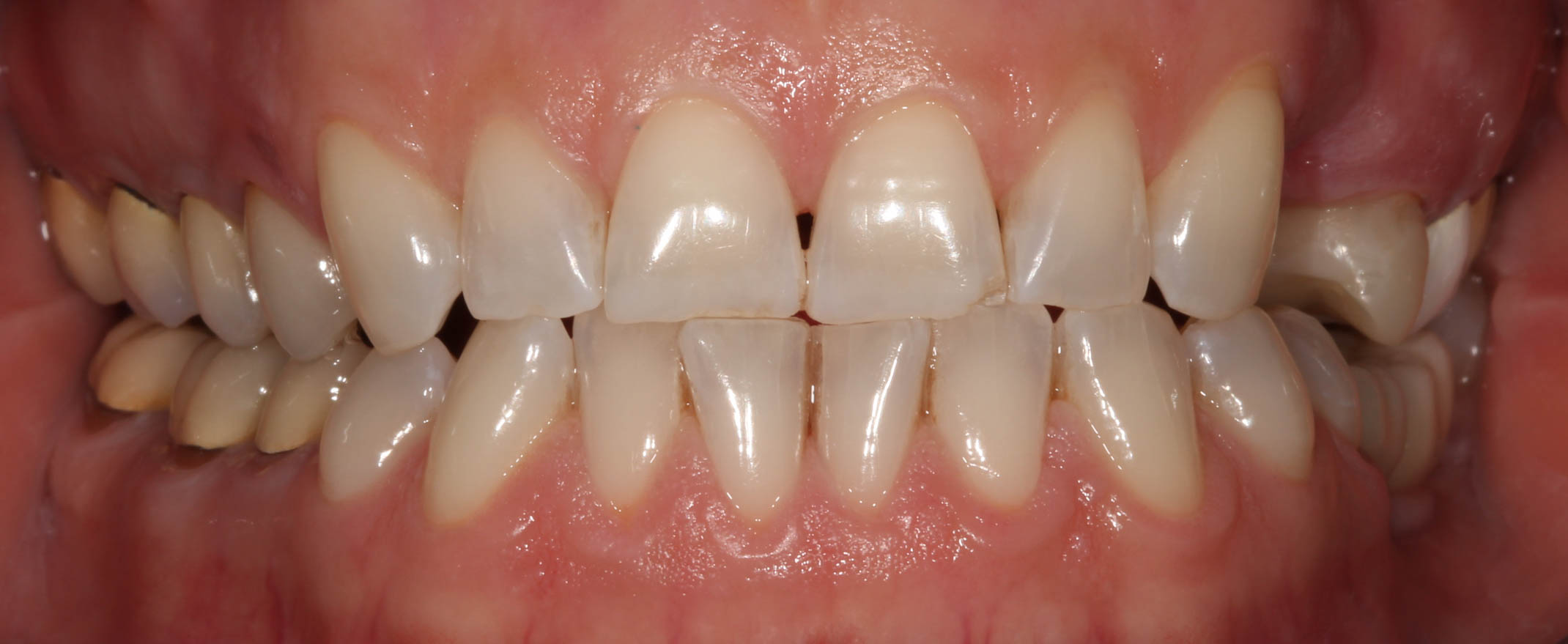 A close up of a person 's teeth with a bridge