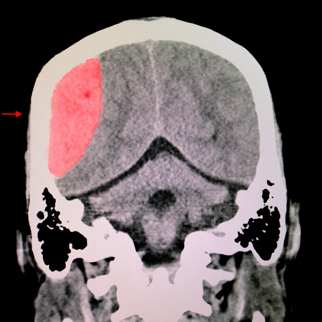 Coronal medical scan of a human brain with a red-highlighted area on the right side indicating a region of interest.